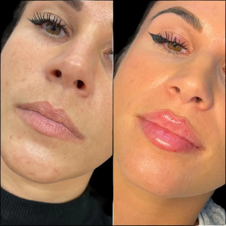 Russian Lip Fillers Treatment in Dubai: The Key to Beautiful, Fuller Lips