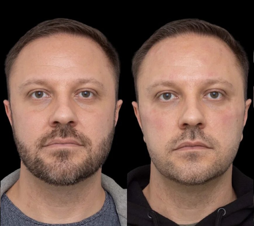 The Role of Celebrity Doctors in Administering Under Eye Fillers Treatment in Dubai