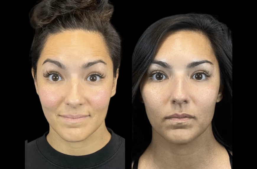 The Ultimate Guide to Botox Treatment in Dubai for First-Timers