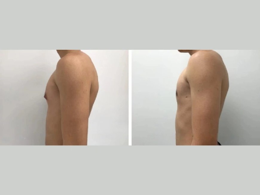 Affordable Excellence: Best Gynecomastia Surgeons in Dubai for Every Budget
