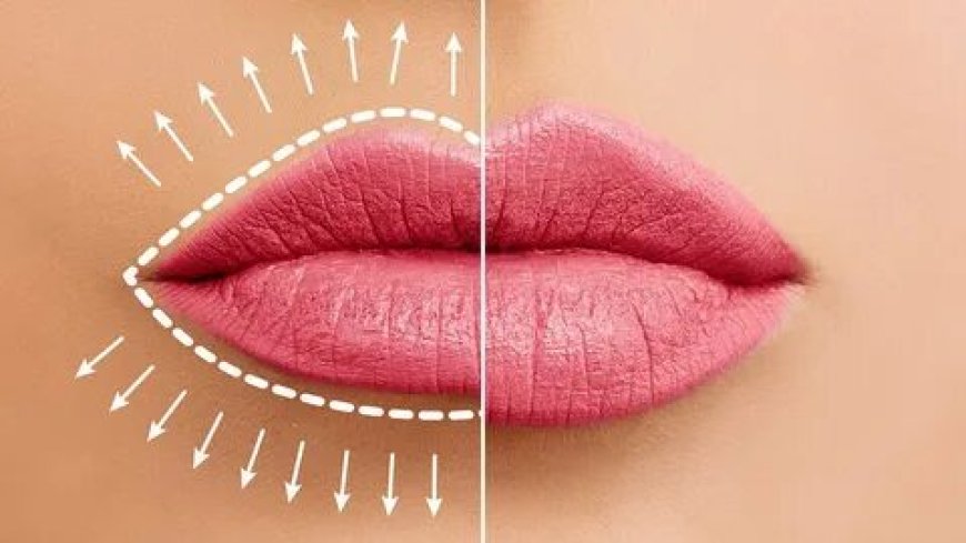 Lip Augmentation Chicago for Fuller, Balanced Lips